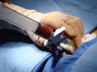 Transplantul de celule stem in Romania – cerere mare, paturi putine