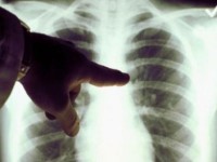 Cele mai noi date referitoare la incidenta tuberculozei in Romania