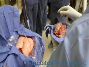 ATR sustine dezvoltarea transplantului pulmonar in Romania, dar in conditii de siguranta pentru pacient