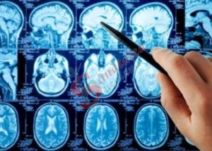 O noua ipoteza cu privire la cauzele aparitiei maladiei Alzheimer