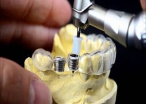 Implanturi dentare 3D mai ieftine, made in China