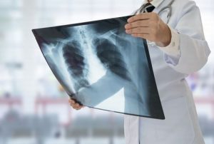 Concediu și indemnizație până la vindecare, pentru pacienții cu tuberculoză