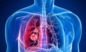 Test on-line pentru evaluarea riscului de cancer pulmonar