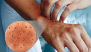 Știi și câștigi sănătate: Dermatita atopică