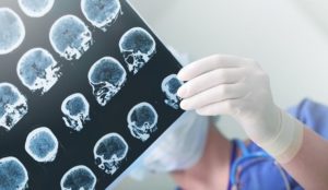Spitalul Județean de Urgență Buzău va avea un Compartiment de Neurochirurgie