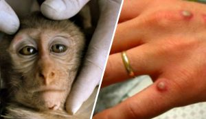 Reuniune de urgență a OMS: „Variola maimuței” a pătruns și în Europa