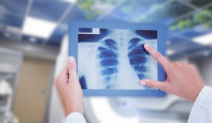 Unul din 15 români riscă să fie diagnosticat cu cancer pulmonar înainte de 75 de ani